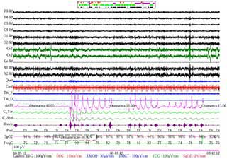 Exame de Polissonografia